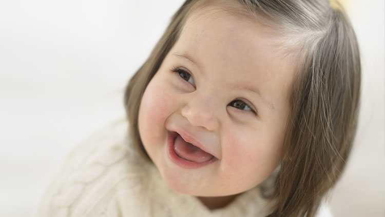 متلازمة داون - صورة ارشيفية