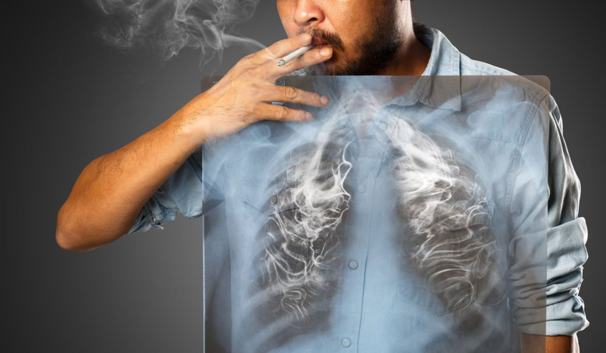 الإصابة بالانسداد الرئوي المزمن