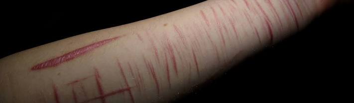 ظاهرة تقطيع اليدين 