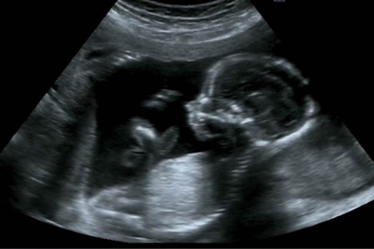 ورم ليفى جنين داخل الرحم اثناء الحمل