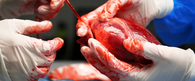 زراعة الأعضاء - صورة أرشيفية