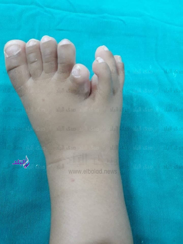 إستئصال قدم زيادة لطفله