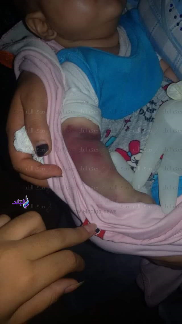 بتر ذراع رضيعة