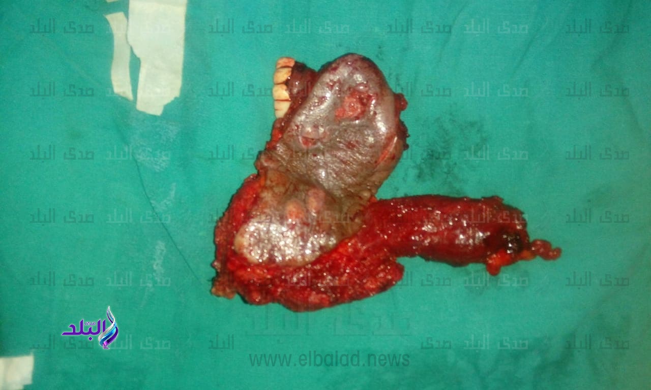 عملية استئصال ورم بالفك بمعهد الاورام 