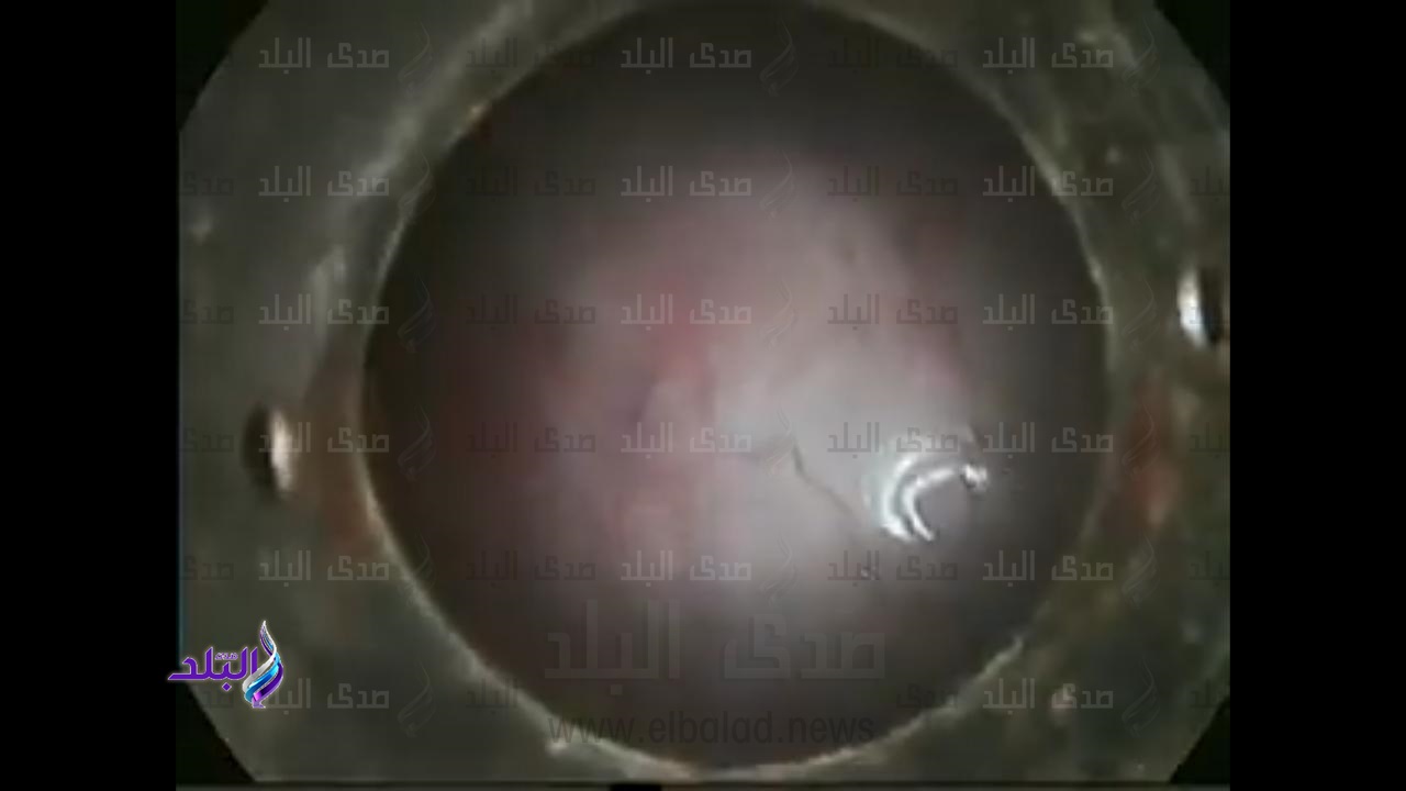 استئصال كيس ضخم على المبيض لسيدة عمرها 28 عامًا بكفر الشيخ