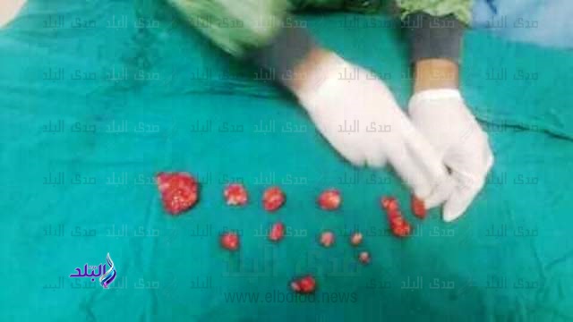 استئصال 14 ورما ليفيا