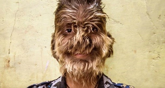 معلومات قد لا تعرفها عن متلازمة الذئب