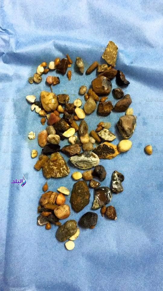 استخراج زلط وسيراميك وطوب من أمعاء مريض بأسيوط استخراج زلط وسيراميك وطوب من أمعاء مريض بأسيوط