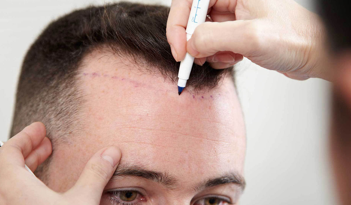 هذا هو العلاج الوحيد للصلع الوراثي.. والخلايا الجذعية كذبة