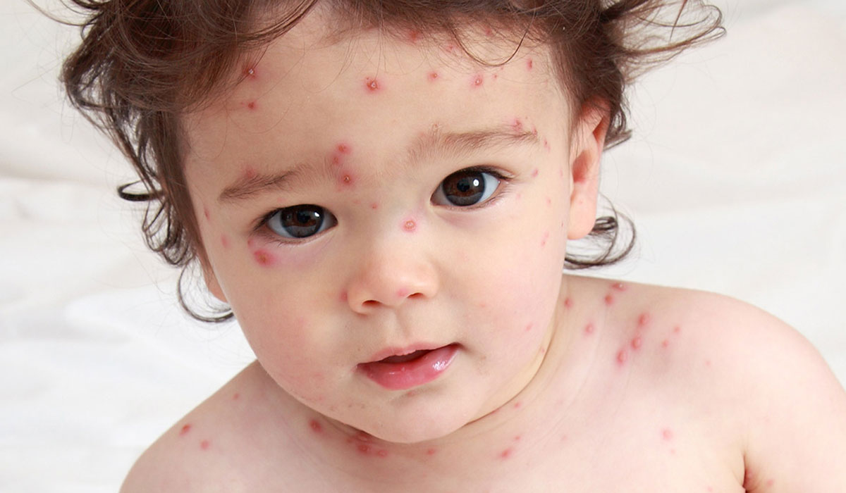 طرق للوقاية من الجدري المائي طرق للوقاية من الجدري المائي