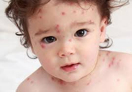 بعد أنتشاره فى مدارس بالأقصر ...كل ما يمكن معرفته عن الجديرى