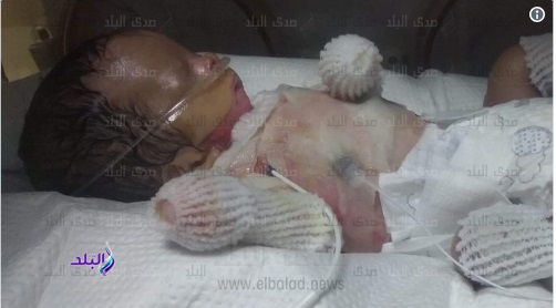 طفل مولود بدون جلد على جسده