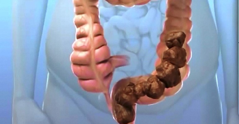 أطعمة لعلاج الأمساك أطعمة لعلاج الأمساك