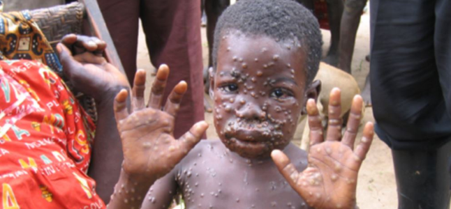 فيروس جدري القردة