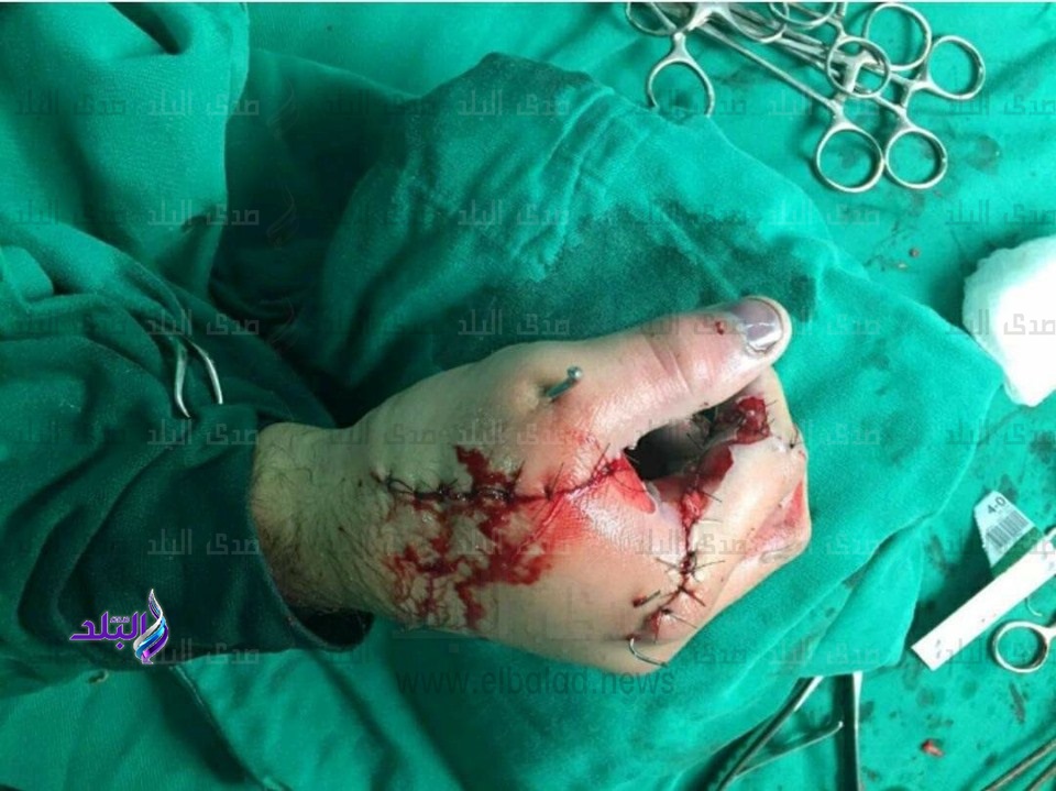 أطباء الأزهر بالحسين الجامعي ينقذون شابا أطباء الأزهر بالحسين الجامعي ينقذون شابا