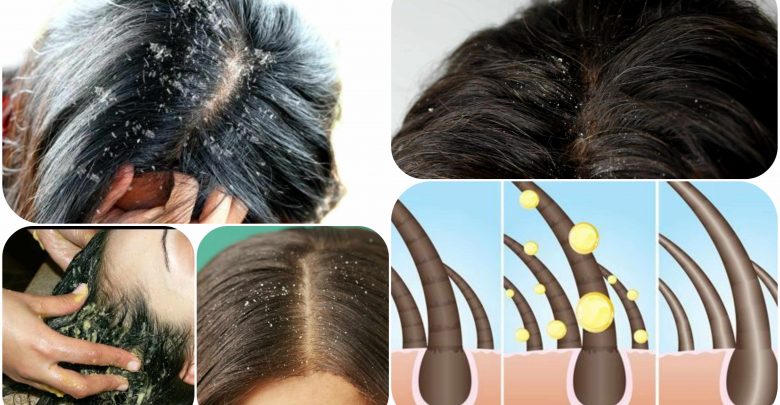 علاج لقشرة الشعر