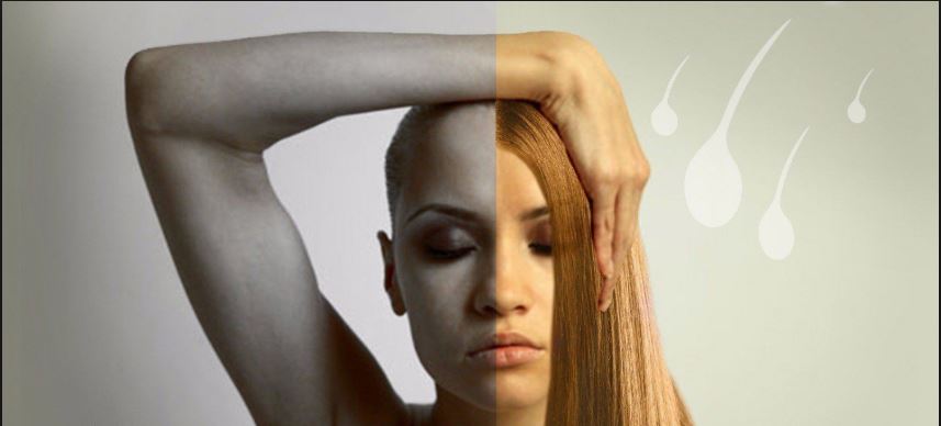 داء الثعلبة