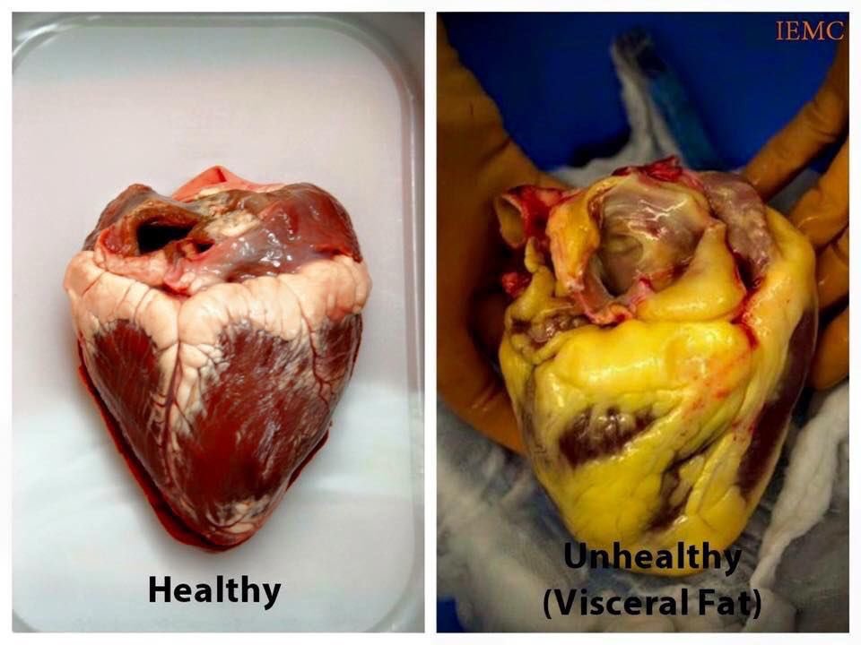 لو عندك دهون على القلب .. دراسة جديدة تفجر مفاجأة 