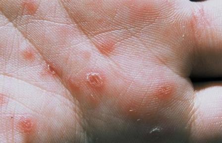 داء العليقي