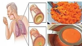 علاج للكحه بالاعشاب 