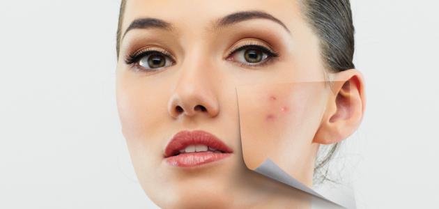 علاج حب الشباب علاج حب الشباب