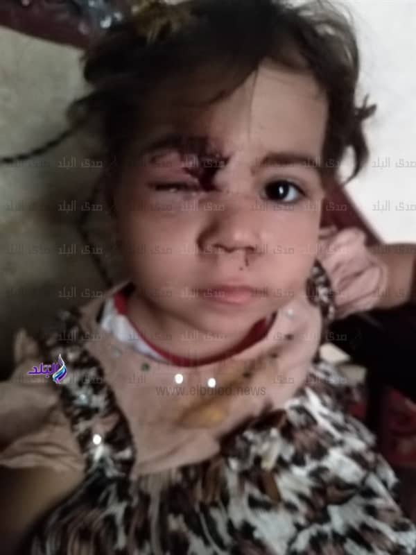 طفلة عقرها كلب بالفيوم طفلة عقرها كلب بالفيوم