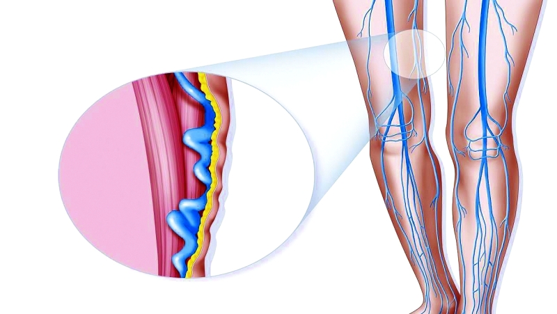 اسباب الدوالى وعلاجها .. اهم الاسباب والحلول لجميع الانواع
