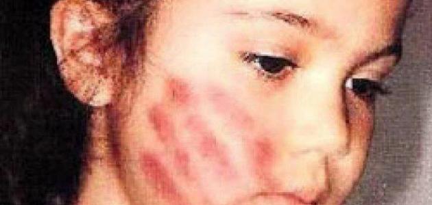 ضرب الاطفال على وجه 