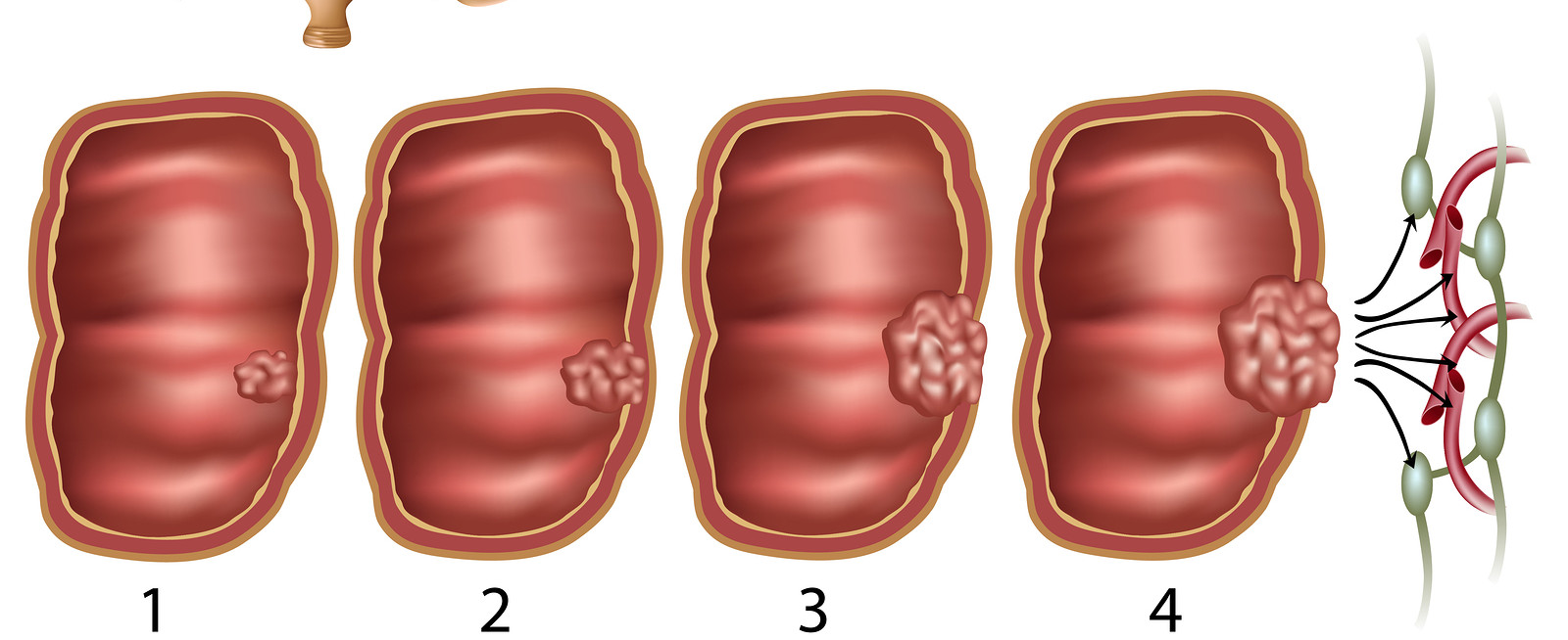 اعراض سرطان القولون