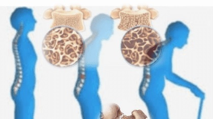 عادات تسبب هشاشة العظام