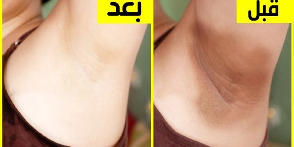 تبييض الاماكن الحساسة تبييض الاماكن الحساسة