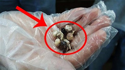 حصوات الكلى حصوات الكلى