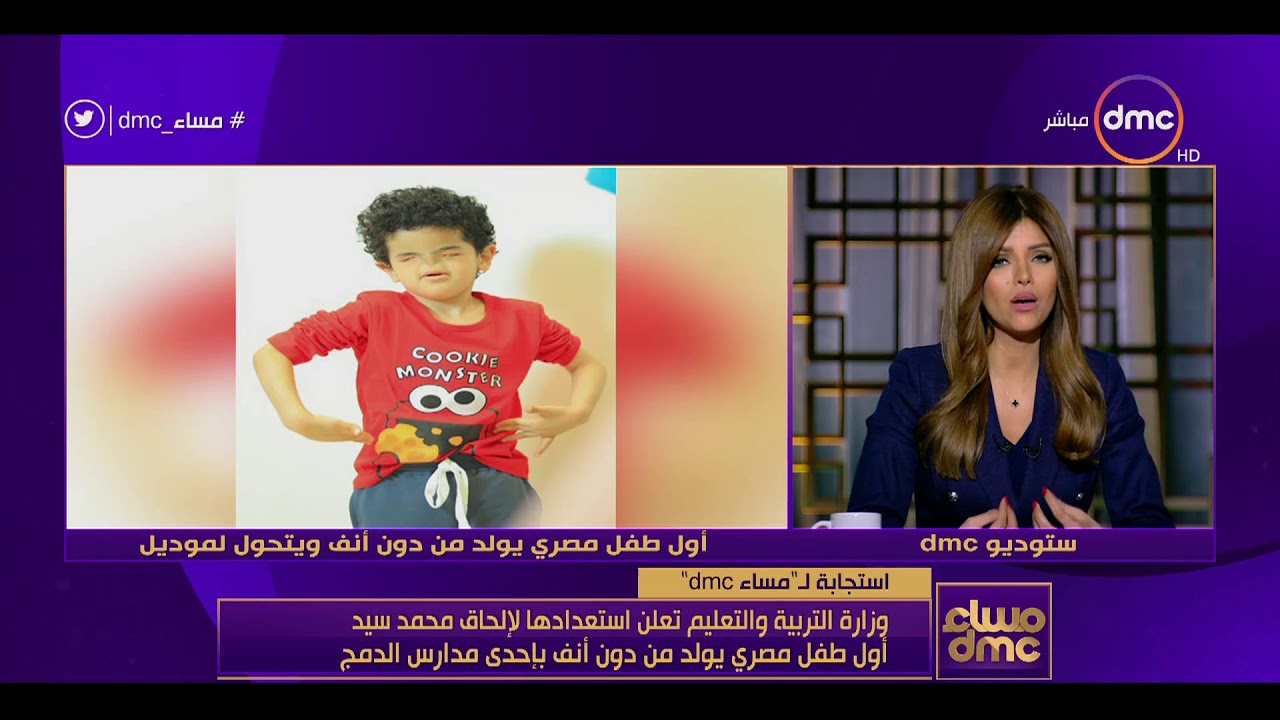 أول طفل مصرى يولد بلا أنف 