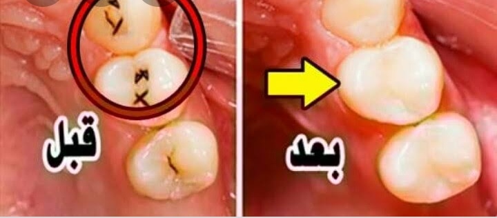 تسوس الأسنان 
