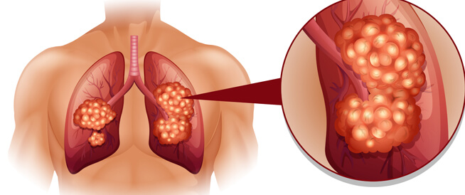 سرطان الرئة 