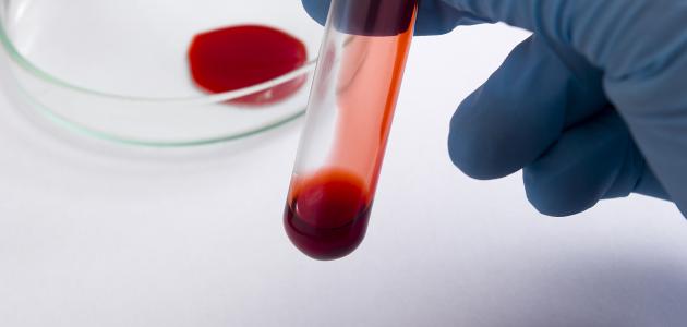 اعراض الاصابة بفيروس سي اعراض الاصابة بفيروس سي