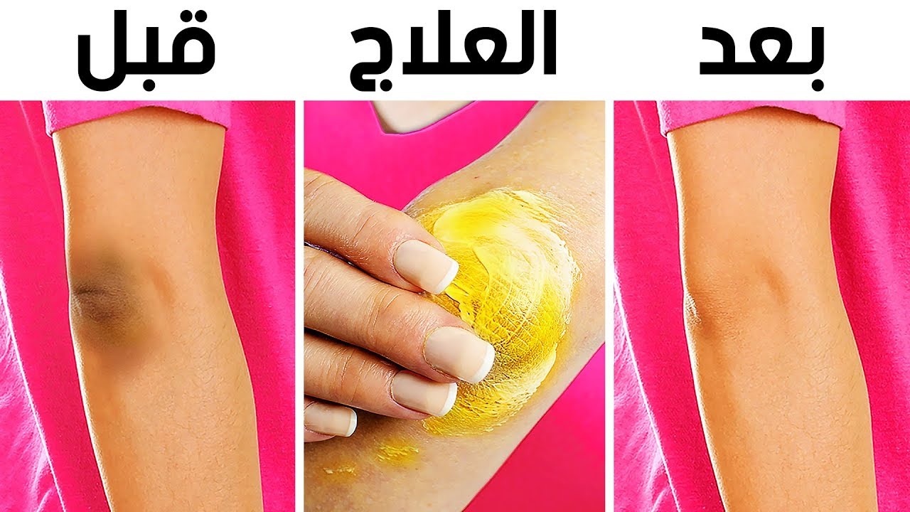 بمكونين من مطبخك :حيلة عجيبة تقضي على اسمرار الركبتين والكوع