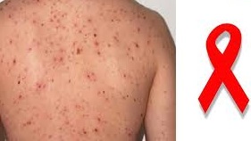 أعراض الايدز