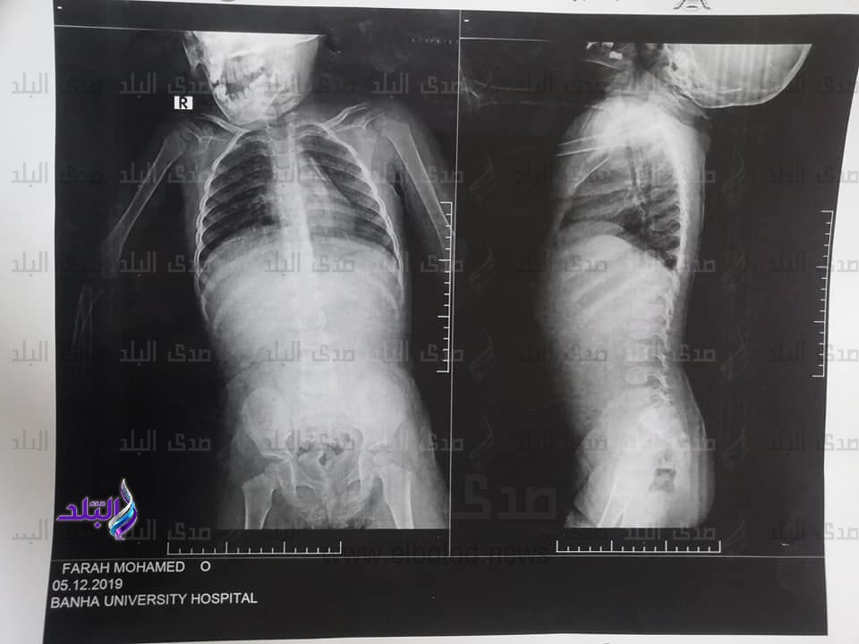 استخراج إبرة استقرت بجوار قلب طفلة بمستشفى بنها الجامعي