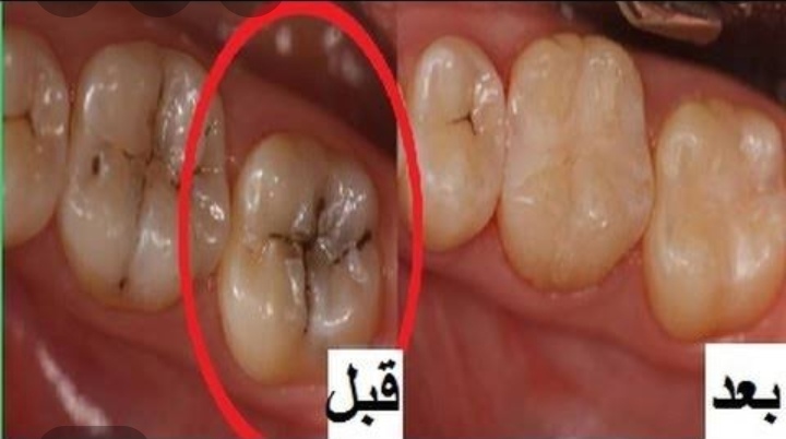فوائد تنظيف الأسنان فوائد تنظيف الأسنان
