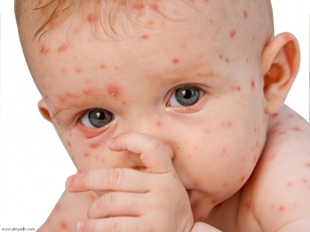 اعراض الجدري