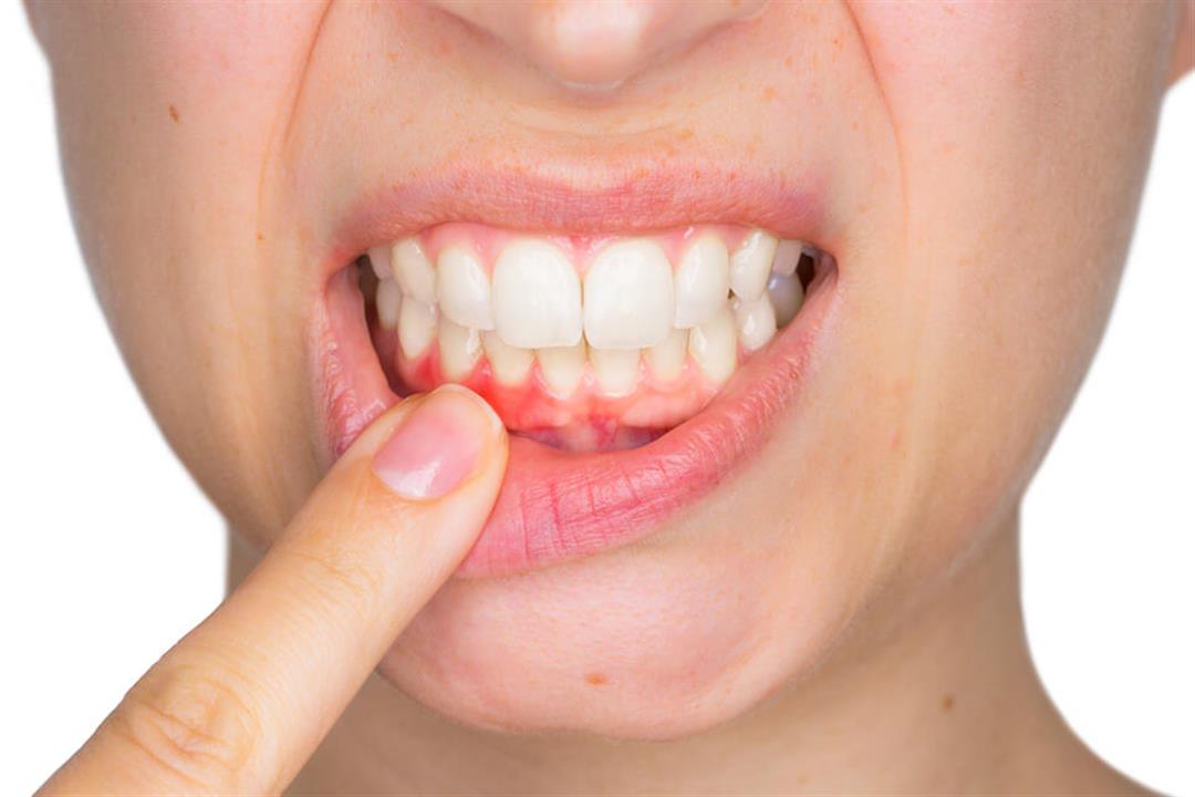 علاجات منزلية لخراج الاسنان علاجات منزلية لخراج الاسنان