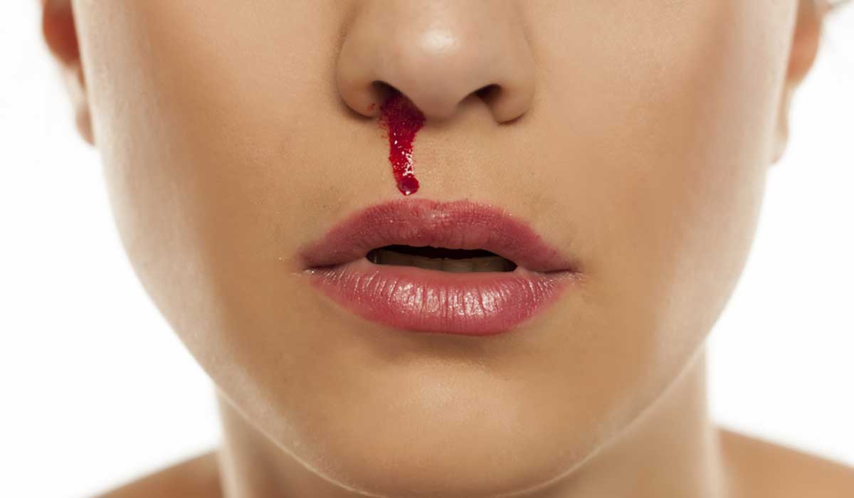 انتبه .. 5 طرق بسيطة لـ وقف نزيف الأنف في دقائق