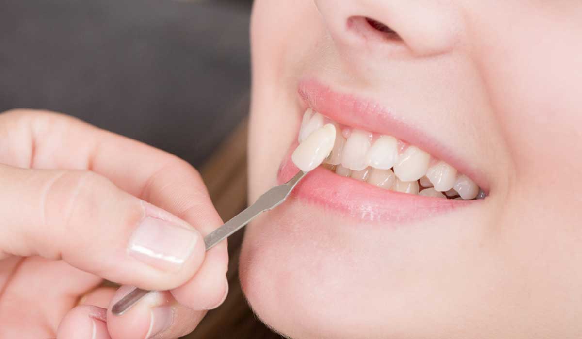  5 حالات تحتاج لتركيب عدسات الأسنان اللاصقة