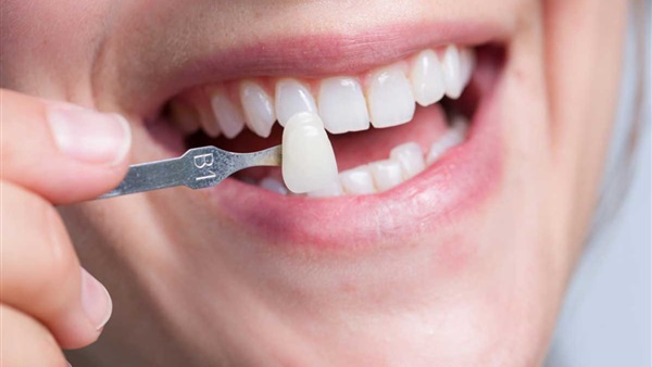 حكم عمل الفينير للأسنان .. هل الفينير يمنع الوضوء