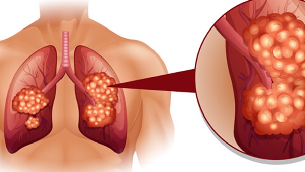 سرطان الرئة .. اكتشف المراحل والعلاج واعراض الورم الحميد 
