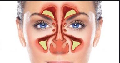 علاج الجيوب الانفية
