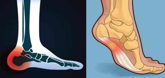 8 علاجات لهشاشة العظام 