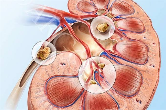 حصوات الكلى 