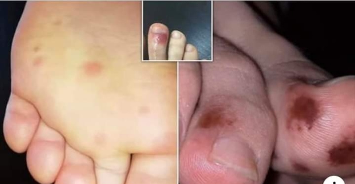 عرض جديد لكورونا يظهر فى القدم 